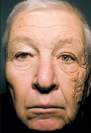 envejecimiento-piel-sol